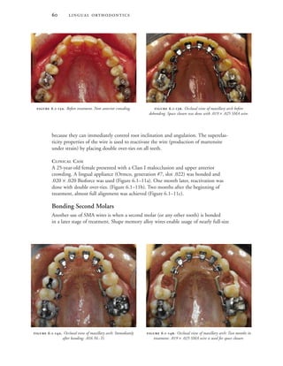  
because they can immediately control root inclination and angulation. The superelas-
ticity properties of the wire is used to reactivate the wire (production of martensite
under strain) by placing double over-ties on all teeth.
CLINICAL CASE
A 25-year-old female presented with a Class I malocclusion and upper anterior
crowding. A lingual appliance (Ormco, generation #7, slot .022) was bonded and
.020 × .020 Bioforce was used (Figure 6.1–11a). One month later, reactivation was
done with double over-ties. (Figure 6.1–11b). Two months after the beginning of
treatment, almost full alignment was achieved (Figure 6.1–11c).
Bonding Second Molars
Another use of SMA wires is when a second molar (or any other tooth) is bonded
in a later stage of treatment. Shape memory alloy wires enable usage of nearly full-size
 .-. Occlusal view of maxillary arch before
debonding. Space closure was done with .019 × .025 SMA wire.
 .-. Before treatment. Note anterior crowding.
 .-. Occlusal view of maxillary arch: Two months in
treatment: .019 × .025 SMA wire is used for space closure.
 .-. Occlusal view of maxillary arch: Immediately
after bonding: .016 Ni.-Ti.
 