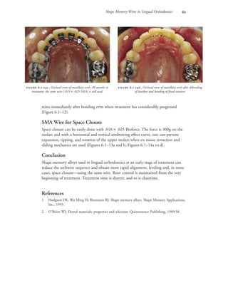 Shape Memory Wires in Lingual Orthodontics 
wires immediately after bonding even when treatment has considerably progressed
(Figure 6.1–12).
SMA Wire for Space Closure
Space closure can be easily done with .018 × .025 Bioforce. The force is 300g on the
molars and with a horizontal and vertical antibowing effect curve, one can prevent
expansion, tipping, and rotation of the upper molars when en masse retraction and
sliding mechanics are used (Figures 6.1–13a and b, Figures 6.1–14a to d).
Conclusion
Shape memory alloys used in lingual orthodontics at an early stage of treatment can
reduce the archwire sequence and obtain more rapid alignment, leveling and, in some
cases, space closure—using the same wire. Root control is maintained from the very
beginning of treatment. Treatment time is shorter, and so is chairtime.
References
1. Hodgson DE, Wu Ming H, Biermann RJ. Shape memory alloys. Shape Memory Applications,
Inc., 1995.
2. O’Brien WJ. Dental materials: properties and selection. Quintessence Publishing, 1989;58.
 .-. Occlusal view of maxillary arch after debonding
of brackets and bonding of fixed retainer.
 .-. Occlusal view of maxillary arch: 20 months in
treatment: the same wire (.019 × .025 SMA) is still used.
 