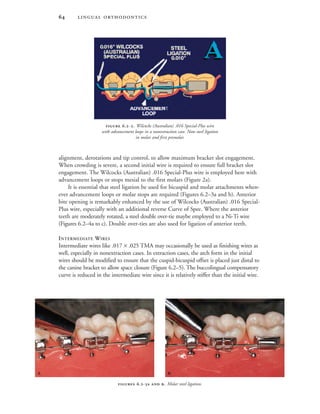  
 .-. Wilcocks (Australian) .016 Special-Plus wire
with advancement loops in a nonextraction case. Note steel ligation
in molar and first premolar.
alignment, derotations and tip control, to allow maximum bracket slot engagement.
When crowding is severe, a second initial wire is required to ensure full bracket slot
engagement. The Wilcocks (Australian) .016 Special-Plus wire is employed here with
advancement loops or stops mesial to the first molars (Figure 2a).
It is essential that steel ligation be used for bicuspid and molar attachments when-
ever advancement loops or molar stops are required (Figures 6.2–3a and b). Anterior
bite opening is remarkably enhanced by the use of Wilcocks (Australian) .016 Special-
Plus wire, especially with an additional reverse Curve of Spee. Where the anterior
teeth are moderately rotated, a steel double over-tie maybe employed to a Ni-Ti wire
(Figures 6.2–4a to c). Double over-ties are also used for ligation of anterior teeth.
INTERMEDIATE WIRES
Intermediate wires like .017 × .025 TMA may occasionally be used as finishing wires as
well, especially in nonextraction cases. In extraction cases, the arch form in the initial
wires should be modified to ensure that the cuspid-bicuspid offset is placed just distal to
the canine bracket to allow space closure (Figure 6.2–5). The buccolingual compensatory
curve is reduced in the intermediate wire since it is relatively stiffer than the initial wire.
 .-  . Molar steel ligation.
 
 