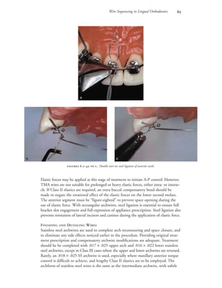 Wire Sequencing in Lingual Orthodontics 
Elastic forces may be applied at this stage of treatment to initiate A-P control. However,
TMA wires are not suitable for prolonged or heavy elastic forces, either intra- or interar-
ch. If Class II elastics are required, an extra buccal compensatory bend should be
made to negate the rotational effect of the elastic forces on the lower second molars.
The anterior segment must be “figure-eighted” to prevent space opening during the
use of elastic force. With rectangular archwires, steel ligation is essential to ensure full
bracket slot engagement and full expression of appliance prescription. Steel ligation also
prevents rerotation of lateral incisors and canines during the application of elastic force.
FINISHING AND DETAILING WIRES
Stainless steel archwires are used to complete arch recontouring and space closure, and
to eliminate any side effects noticed earlier in the procedure. Providing original treat-
ment prescription and compensatory archwire modifications are adequate. Treatment
should be be completed with .017 × .025 upper arch and .016 × .022 lower stainless
steel archwires, except in Class III cases where the upper and lower archwires are reversed.
Rarely, an .018 × .025 SS archwire is used, especially where maxillary anterior torque
control is difficult to achieve, and lengthy Class II elastics are to be employed. The
archform of stainless steel wires is the same as the intermediate archwire, with subtle
 .-  . Double over-tie steel ligation of anterior teeth.

 
 