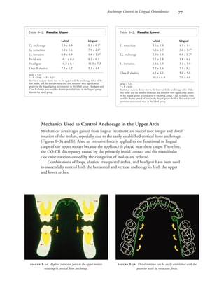 Anchorage Control in Lingual Orthodontics 
Mechanics Used to Control Anchorage in the Upper Arch
Mechanical advantages gained from lingual treatment are buccal root torque and distal
rotation of the molars, especially due to the easily established cortical bone anchorage
(Figures 8–3a and b). Also, an intrusive force is applied to the functional or lingual
cusps of the upper molars because the appliance is placed near these cusps. Therefore,
the CO-CR discrepancy caused by the primarily initial contact and the mandibular
clockwise rotation caused by the elongation of molars are reduced.
Combinations of loops, elastics, transpalatal arches, and headgear have been used
to successfully control both the horizontal and vertical anchorage in both the upper
and lower arches.
 -. Applied intrusion force to the upper molars
resulting in cortical bone anchorage.
 -. Distal rotation can be easily established with the
posterior teeth by retraction forces.
Table 8–1. Results: Upper
Labial Lingual
U6 anchorage 2.0 ± 0.9 0.1 ± 0.5†
U1 retraction 5.0 ± 1.6 7.9 ± 2.0†
U1 intrusion 0.9 ± 0.9 1.8 ± 1.6*
Facial axis –0.1 ± 0.8 0.1 ± 0.3
Head gear 16.3 ± 6.1 11.3 ± 7.3
Class II elastics 7.5 ± 6.2 5.3 ± 4.8
mean ± S.D.
* = P < 0.05; †
= P < 0.01
Statistical analysis shows that in the upper arch the anchorage value of the
first molar, and the anterior retraction and intrusion were significantly
greater in the lingual group as compared to the labial group. Headgear and
Class II elastics were used for shorter period of time in the lingual group
than in the labial group.
Table 8–2. Results: Lower
Labial Lingual
L1 retraction 3.6 ± 1.9 4.1 ± 1.4
1.4 ± 1.9 3.6 ± 1.3*
U6 anchorage 2.0 ± 1.3 0.9 ± 0.7*
2.1 ± 1.8 1.8 ± 0.8
L1 intrusion 2.4 ± 1.3 3.1 ± 1.0
2.2 ± 1.4 2.1 ± 0.3
Class II elastics 6.1 ± 6.1 5.6 ± 5.0
10.8 ± 6.8 7.6 ± 4.0
mean ± S.D.
* = P < 0.05
Statistical analysis shows that in the lower arch the anchorage value of the
first molar and the anterior retraction and intrusion were significantly greater
in the lingual group as compared to the labial group. Class II elastics were
used for shorter period of time in the lingual group (both in first and second
premolar extractions) than in the labial group.
 