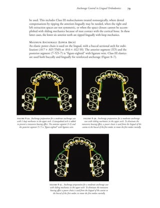 Anchorage Control in Lingual Orthodontics 
be used. This includes Class III malocclusions treated nonsurgically, where dental
compensations by tipping the anteriors lingually may be needed, when the right and
left extraction spaces are not symmetric, or when the space closure cannot be accom-
plished with sliding mechanics because of root contact with the cortical bone. In these
latter cases, the lower six anterior teeth are tipped lingually with loop mechanics.
MAXIMUM ANCHORAGE (LOWER ARCH)
An elastic power chain is used on the lingual, with a buccal sectional arch for stabi-
lization (.017 × .025 TMA or .016 × .022 SS). The anterior segment (3|3) and the
posterior segment (7–5|5–7) is “figure-eighted” with ligature wire. Class III elastics
are used both buccally and lingually for reinforced anchorage (Figure 8–7).
 -. Anchorage preparation for a moderate anchorage case
with L-loop mechanics in the upper arch. A transpalatal arch is added
to prevent a transverse bowing effect. The anterior segment (3-3) and
the posterior segment (5-7) is “figure-eighted” with ligature wire.
 -. Anchorage preparation for a moderate anchorage
case with sliding mechanics in the upper arch. To eliminate the
transverse bowing effect, a power chain is used from the lingual of the
canine to the buccal of the first molar, to rotate the first molars mesially.
 -. Anchorage preparation for a moderate anchorage case
with sliding mechanics in the upper arch. To eliminate the transverse
bowing effect a power chain is used from the lingual of the canine to
the buccal of the first molar, to rotate the first molars mesially.
 