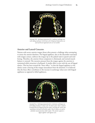 Anchorage Control in Lingual Orthodontics 
Anterior and Lateral Concerns
Patients with severe anterior tongue thrust often present a challenge when attempting
to retract the anterior dentition. The lingual appliance, due to the discomfort associated
with tongue contact, redirects the tongue tip to the palatal vault in speech and swal-
lowing. Therefore, the anterior thrust component is eliminated, and normal muscle
balance is restored. The excessive pressure from the tongue against the anteriors is
minimized while retraction is facilitated. A similar effect is seen with the use of lingual
elastics. This has been termed the “fence effect,” in that the lingual appliance or the
elastics create a fencing of the tongue musculature from the dentition. It is believed
that the fence effect contributes to the increase in anchorage values seen with lingual
appliances as opposed to labial appliances.
 -. Anchorage preparation for a minimum anchorage case
with sliding mechanics in lower arch. An elastic power chain is placed
circularly from the lingual of the first molar, encircling the canine and
attaching to the buccal of the first molar. Class II elastics are used to
facilitate mesial movement of the molars. The anterior segment is
“figure-eighted” with ligature wire.
 -. Anchorage preparation for a moderate anchorage case
with sliding mechanics in the lower arch. Reciprocal elastic forces are
used and buccal segmental wires are not needed.
 