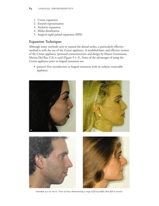  
1. Crozat expansion
2. Enamel reproximation
3. Archwire expansion
4. Molar distalization
5. Surgical rapid palatal expansion (RPE)
Expansion Techniques
Although many methods exist to expand the dental arches, a particularly effective
method is with the use of the Crozat appliance. A modified basic and effective version
of the Crozat appliance (personal communication and design by Duane Grummons,
Marina Del Rey, CA) is used (Figure 9.1–3). Some of the advantages of using the
Crozat appliance prior to lingual treatment are:
• patient’s first introduction to lingual treatment with an esthetic removable
appliance
 .-  . Series of views demonstrating a range of facial profiles from full to concave.
 
 
 