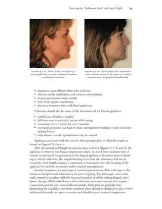 Preserving the “Hollywood Smile” and Facial Profile 
• expansion more efficient than with archwires
• effective molar distalization and rotation when desired
• incisor proclination when needed
• little if any speech interference
• decreases treatment time with fixed appliances
Clinicians should also be aware of the limitations of the Crozat appliance:
• careful case selection is needed
• full-time wear is indicated, except while eating
• activations every 3 weeks for 4 to 5 months
• too much activation can lead to tissue impingement resulting in pain and more
tipping forces
• early-release enamel reproximation may be needed
Appliance activation with the use of a three-pronged plier is relatively simple as
shown in Figures 9.1–4a to c.
After the desired arch length increase has been achieved (Figures 9.1–5a and b), the
appliance is removed and lingual impressions taken. A clear 1 mm vacuform type of
retainer is used until the placement of the lingual appliance. Retention prior to bond-
ing is critical, otherwise, the lingual bonding trays from the laboratory will not fit
accurately. Arch length increase is continued or maintained after the bonding of the
appliance by archwire expansion and/or enamel reproximation.
Another nonextraction technique is enamel reproximation. This technique is also
known as interproximal reduction or air rotor stripping. The technique, once rarely
used, seemed to resurface with the increased number of adults seeking lingual ortho-
dontic therapy. Adult orthodontics often eliminates treatment options that require
cooperation and are not cosmetically acceptable. Adult patients generally have
demanding life schedules; therefore, treatment plans should be designed to place fewer
additional demands on regular activities and should require minimal cooperation.
 .-. Patient profile view depicting a
concave profile due to previous orthodontic treatment
with bicuspid extractions.
 .-. Patient profile shows improvement
and a moderate increase in lip support as a result of
extraction spaces being opened orthodontically.
 