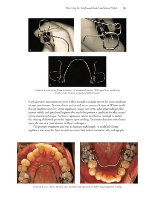 Preserving the “Hollywood Smile” and Facial Profile 
Cephalometric measurements were within normal standards except for some moderate
incisor proclination. Narrow dental arches and an accentuated Curve of Wilson made
this an excellent case for Crozat expansion. Large-size teeth, substantial radiographic
enamel width, and good oral hygiene also made this patient a candidate for the enamel
reproximation technique. Archwire expansion can be an effective method to reduce
the existing shadowed premolar regions upon smiling. Treatment decisions were based
upon the use of a combination of these techniques.
The primary treatment goal was to increase arch length. A modified Crozat
appliance was worn for four months to rotate first molars mesiobuccally and upright
 .-  . Crozat activation: (a) mesiobuccal rotation, (b) bicuspid arms moved away
to allow molar rotation, (c) appliance fully activated.
 .-  . Occlusal views during Crozat expansion just before lingual appliance bonding.



 
 