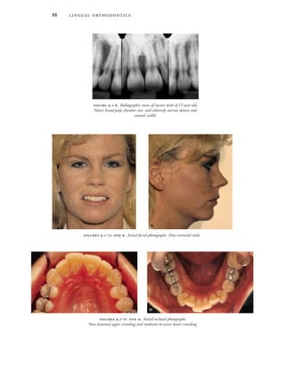  
 .-  . Initial facial photographs. Note restricted smile.
 
 .-  . Initial occlusal photographs.
Note minimal upper crowding and moderate-to-severe lower crowding.
 
 .-. Radiographic views of incisor teeth of 15-year-old.
Notice broad pulp chamber size, and relatively narrow dentin and
enamel width.
 