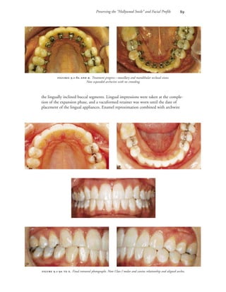 .-  . Final intraoral photographs. Note Class I molar and canine relationship and aligned arches.
Preserving the “Hollywood Smile” and Facial Profile 
the lingually inclined buccal segments. Lingual impressions were taken at the comple-
tion of the expansion phase, and a vacuformed retainer was worn until the date of
placement of the lingual appliances. Enamel reproximation combined with archwire
 .-  . Treatment progress—maxillary and mandibular occlusal views.
Note expanded archwires with no crowding.
 
 



 