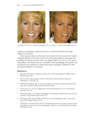  
expansion completed the expansion necessary to achieve the desired arch length
(Figures 9.1–8a and b).
Total treatment time was 20 months, four months of Crozat wear and 16 months
of lingual appliances. The Class I molar and canine relationship was maintained, the
crowding was relieved, and the arches were aligned (Figures 9.1–9a to e). The incisor
relationship to the denture base was normalized. Tooth morphology, facial profile, and
lip position were maintained. A broad, unrestricted, and happy “Hollywood” smile
was achieved (Figures 9.1–9f and g).
References
1. Angle EH. Treatment of malocclusion of the teeth. 7th Ed. Philadelphia: SS White Dental
Manufacturing, 1907.
2. Peck S, Peck L. Selected aspects of the Art and Science of Facial Esthetics Seminar in
Orthodontics, 1995;105–126.
3. Radlanski RJ, Ralph R, Jager A, Zimmer B. Plaque accumulation caused by interdental strip-
ping. Am J Orthod Dentofac Orthop 1988;94:416–420.
4. Twesme DA, et al. Air rotor stripping and enamel demineralization in vitro. Am J Orthod
1994;105:142–152.
5. Radlanski RJ, Jager A, Zimmer B. Morphology of interdentally stripped enamel one year after
treatment. J Clin Orthod 1989;23:748–750.
6. El-Mangoury NH, Moussa MM, Mostafa YA. In vitro remineralization after air rotor strip-
ping. J Clin Orthod 1991;25:75–78.
7. Thordasson A, Zachrisson BU, Mjor IA. Remodeling of canines to the shape of lateral incisors
by grinding: a long-term clinical and radiographic evaluation. Am J Orthod Dentofac Orthop
1991;100:123–132.
 .-  . Final facial photographs. Note nice, progressive, round and broad “Hollywood” smile.
 
 