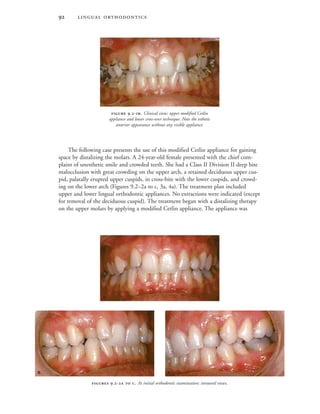  
The following case presents the use of this modified Cetlin appliance for gaining
space by distalizing the molars. A 24-year-old female presented with the chief com-
plaint of unesthetic smile and crowded teeth. She had a Class II Division II deep bite
malocclusion with great crowding on the upper arch, a retained deciduous upper cus-
pid, palatally erupted upper cuspids, in cross-bite with the lower cuspids, and crowd-
ing on the lower arch (Figures 9.2–2a to c, 3a, 4a). The treatment plan included
upper and lower lingual orthodontic appliances. No extractions were indicated (except
for removal of the deciduous cuspid). The treatment began with a distalizing therapy
on the upper molars by applying a modified Cetlin appliance. The appliance was
 .-  . At initial orthodontic examination: intraoral views.

 
 .-. Clinical view: upper modified Cetlin
appliance and lower cross-over technique. Note the esthetic
anterior appearance without any visible appliance.
 