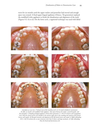 Distalization of Molars in Nonextraction Cases 
 
 
 
 .-  . Occlusal views of the maxillary arch: (a) At initial orthodontic examination.
(b) After six months with modified Cetlin appliance. Note spaces between the molars, second bicuspids, and
first bicuspids. (c) Bonding of lingual appliance (Ormco-Kurz generation 7). .016 SS archwire with transpalatal
arch. Only the central incisors were bonded in the anterior region due to the crowding and rotations of the lateral
incisors and cuspids. (d) Bicuspid retraction and alignment of the left lateral incisor and cuspid. (e) Before debonding:
.016 × .022 SS archwire for en mass retraction with Class II elastics and loops mechanics. (f) After debonding.
Note the broad and harmonious arch.
worn for six months until the upper molars and premolars had moved and enough
space was created. A fixed upper lingual appliance (Ormco, 7th generation) replaced
the modified Cetlin appliance to finish the distalization and alignment of the teeth
(Figures 9.2–3a to d). On the lower arch, a segmental technique was used with labial
 