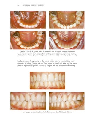  
brackets from the first premolar to the second molar. Later, it was combined with
cross-over technique (lingual brackets from cuspid to cuspid and labial brackets on the
posterior segments) (Figures 9.2–4a to d). Lingual brackets were mounted by using
 .-  . Completion of orthodontic treatment: clinical facial and profile views.
 

 
 
 .-  . Occlusal view of the mandibulary arch: (a) At initial orthodontic examination.
(b) Cross-over technique: labial brackets on posterior segments and lingual brackets on the anterior segment.
Note the extraction of second right molar due to prosthetic considerations. (c) Before debonding. (d) After debonding.
 
