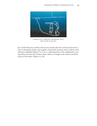 Distalization of Molars in Nonextraction Cases 
 .-. Cephalometric superimposition tracing:
before and after the treatment.
the CLASS laboratory method. Twenty-four months after the treatment had started, a
Class I relationship (molars and cuspids), a functional occlusion, and an esthetic smile
had been established (Figures 9.2–5a to c). Superimposition of the cephalometric trac-
ings before and after the treatment shows almost no change in the incisors and distal-
ization of the molars. (Figure 9.2–5d).
 