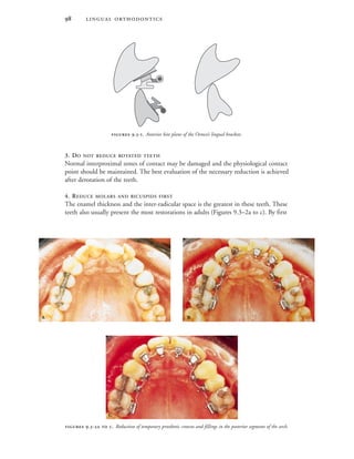  
3. DO NOT REDUCE ROTATED TEETH
Normal interproximal zones of contact may be damaged and the physiological contact
point should be maintained. The best evaluation of the necessary reduction is achieved
after derotation of the teeth.
4. REDUCE MOLARS AND BICUSPIDS FIRST
The enamel thickness and the inter-radicular space is the greatest in these teeth. These
teeth also usually present the most restorations in adults (Figures 9.3–2a to c). By first
 .-. Anterior bite plane of the Ormco’s lingual brackets.
 .-  . Reduction of temporary prosthetic crowns and fillings in the posterior segments of the arch.
 

 