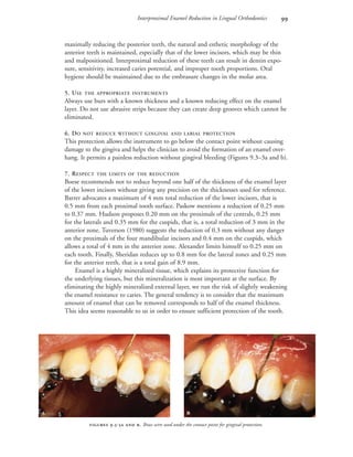 Interproximal Enamel Reduction in Lingual Orthodontics 
maximally reducing the posterior teeth, the natural and esthetic morphology of the
anterior teeth is maintained, especially that of the lower incisors, which may be thin
and malpositioned. Interproximal reduction of these teeth can result in dentin expo-
sure, sensitivity, increased caries potential, and improper tooth proportions. Oral
hygiene should be maintained due to the embrasure changes in the molar area.
5. USE THE APPROPRIATE INSTRUMENTS
Always use burs with a known thickness and a known reducing effect on the enamel
layer. Do not use abrasive strips because they can create deep grooves which cannot be
eliminated.
6. DO NOT REDUCE WITHOUT GINGIVAL AND LABIAL PROTECTION
This protection allows the instrument to go below the contact point without causing
damage to the gingiva and helps the clinician to avoid the formation of an enamel over-
hang. It permits a painless reduction without gingival bleeding (Figures 9.3–3a and b).
7. RESPECT THE LIMITS OF THE REDUCTION
Boese recommends not to reduce beyond one half of the thickness of the enamel layer
of the lower incisors without giving any precision on the thicknesses used for reference.
Barrer advocates a maximum of 4 mm total reduction of the lower incisors, that is
0.5 mm from each proximal tooth surface. Paskow mentions a reduction of 0.25 mm
to 0.37 mm. Hudson proposes 0.20 mm on the proximals of the centrals, 0.25 mm
for the laterals and 0.35 mm for the cuspids, that is, a total reduction of 3 mm in the
anterior zone. Tuverson (1980) suggests the reduction of 0.3 mm without any danger
on the proximals of the four mandibular incisors and 0.4 mm on the cuspids, which
allows a total of 4 mm in the anterior zone. Alexander limits himself to 0.25 mm on
each tooth. Finally, Sheridan reduces up to 0.8 mm for the lateral zones and 0.25 mm
for the anterior teeth, that is a total gain of 8.9 mm.
Enamel is a highly mineralized tissue, which explains its protective function for
the underlying tissues, but this mineralization is most important at the surface. By
eliminating the highly mineralized external layer, we run the risk of slightly weakening
the enamel resistance to caries. The general tendency is to consider that the maximum
amount of enamel that can be removed corresponds to half of the enamel thickness.
This idea seems reasonable to us in order to ensure sufficient protection of the tooth.
 .-  . Brass wire used under the contact point for gingival protection.
 
 