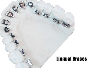 Lingual Braces
 