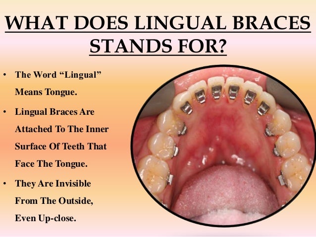 lingual braces barca fontanacountryinn com lingual braces