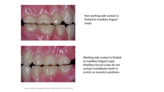 lingualized occlusion in complete dentures.pptx