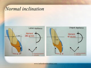 Normal inclination
www.indiandentalacademy.com
 
