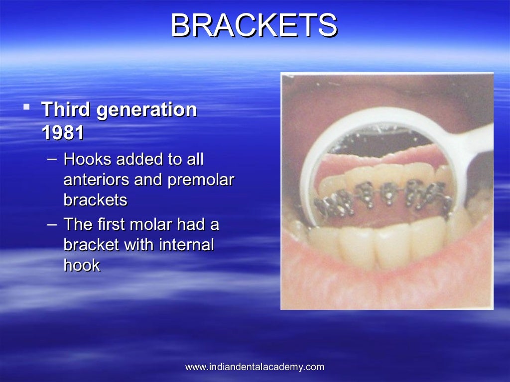 Lingual orthodontics /certified fixed orthodontic courses by Indian