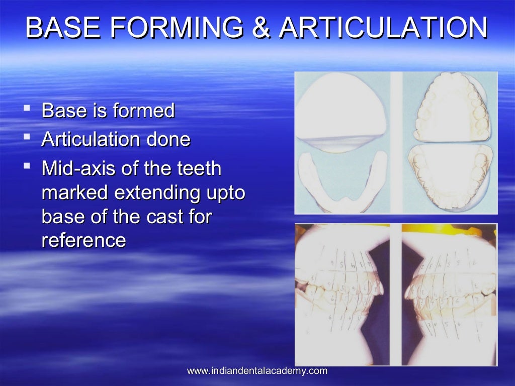 Lingual orthodontics /certified fixed orthodontic courses by Indian