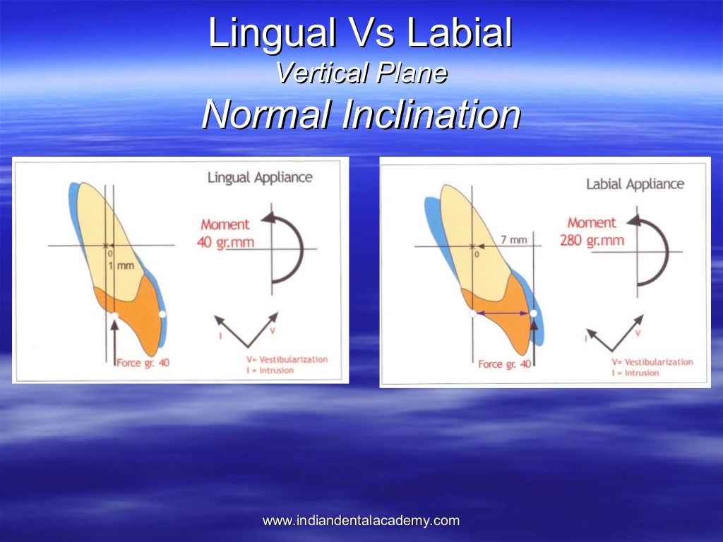 Lingual orthodontics /certified fixed orthodontic courses by Indian