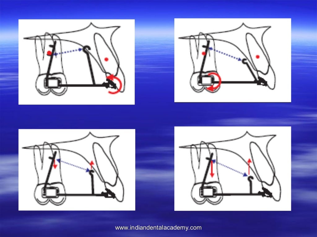 Lingual orthodontics /certified fixed orthodontic courses by Indian