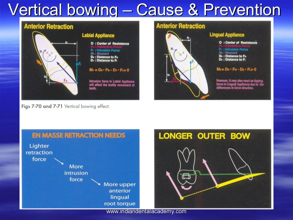 Lingual orthodontics /certified fixed orthodontic courses by Indian