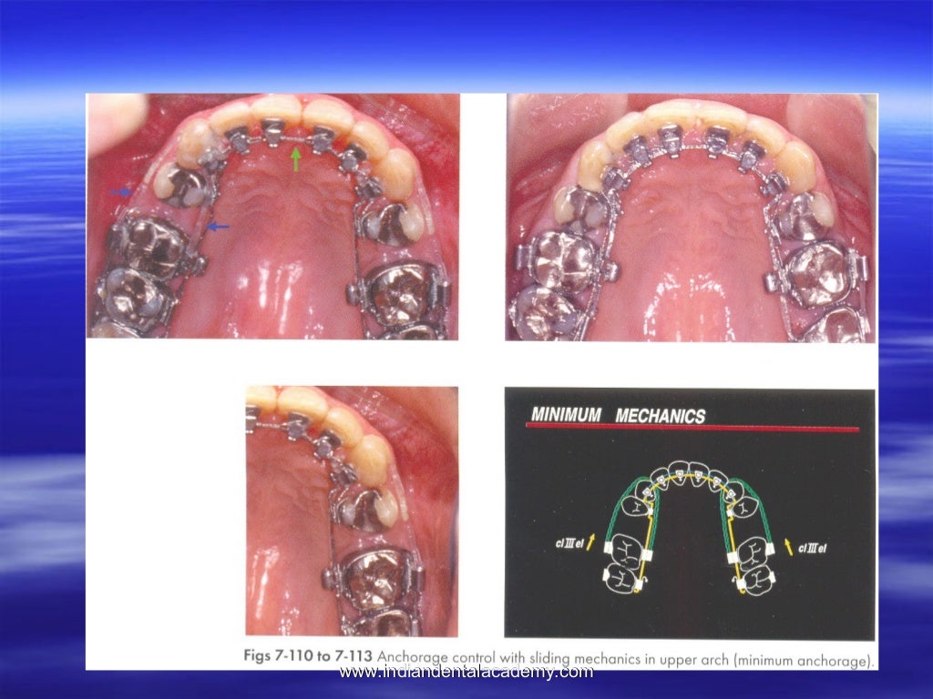 Lingual orthodontics /certified fixed orthodontic courses by Indian