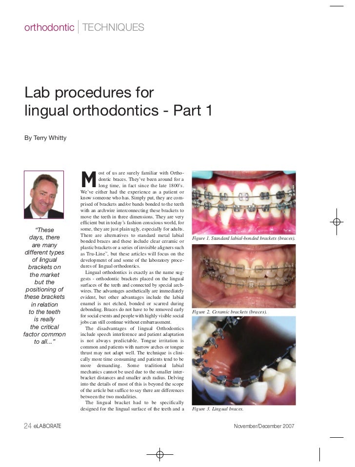 Lingual Orthodontics