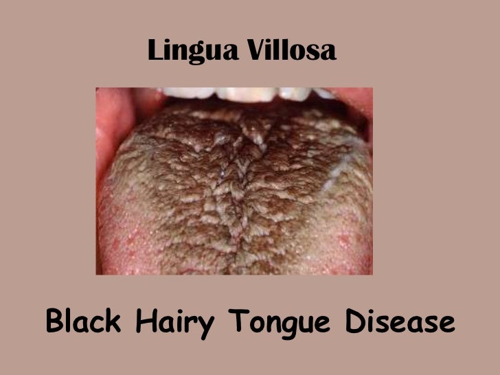 Lingua villosa