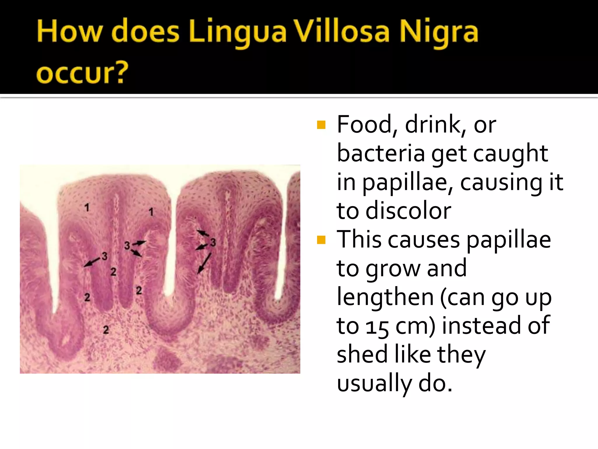 Lingua villosa nigra | PPT