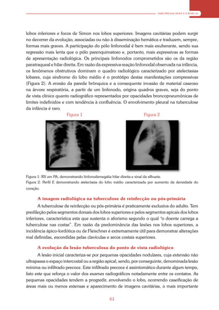 ABORDAGEM CLÍNICA




lobos inferiores e focos de Simon nos lobos superiores. Imagens cavitárias podem surgir
no decorrer da evolução, associadas ou não à disseminação hemática e traduzem, sempre,
formas mais graves. A participação do pólo linfonodal é bem mais exuberante, sendo sua
regressão mais lenta que o pólo parenquimatoso e, portanto, mais expressivas as formas
de apresentação radiológica. Os principais linfonodos comprometidos são os da região
paratraqueal e hilar direita. Em razão da expressiva reação linfonodal observada na infância,
os fenômenos obstrutivos dominam o quadro radiológico caracterizado por atelectasias
lobares, cuja síndrome do lobo médio é o protótipo destas manifestações compressivas
(Figura 2). A erosão da parede brônquica e a consequente invasão de material caseoso
na árvore respiratória, a partir de um linfonodo, origina quadros graves, seja do ponto
de vista clínico quanto radiográfico representados por opacidades broncopneumônicas de
limites indefinidos e com tendência à confluência. O envolvimento pleural na tuberculose
da infância é raro.
                       Figura 1                                  Figura 2




Figura 1: RX em PA, demonstrando linfonodemegalia hilar direita e sinal da silhueta.
Figura 2: Perfil E demonstrando atelectasia do lobo médio caracterizada por aumento da densidade do
coração.

      A imagem radiológica na tuberculose de reinfecção ou pós-primária
       A tuberculose de reinfecção ou pós-primária é praticamente exclusiva do adulto. Tem
predileção pelos segmentos dorsais dos lobos superiores e pelos segmentos apicais dos lobos
inferiores, característica esta que sustenta o aforismo segundo o qual “o doente carrega a
tuberculose nas costas”. Em razão da predominância das lesões nos lobos superiores, a
incidência ápico-lordótica ou de Fleischner é extremamente útil para demonstrar alterações
mal definidas, escondidas pelas clavículas e arcos costais superiores.

      A evolução da lesão tuberculosa do ponto de vista radiológico
      A lesão inicial caracteriza-se por pequenas opacidades nodulares, cuja extensão não
ultrapassa o espaço intercostal ou a região apical, sendo, por conseguinte, denominada lesão
mínima ou infiltrado precoce. Este infiltrado precoce é assintomático durante algum tempo,
fato este que reforça o valor dos exames radiográficos notadamente entre os contatos. As
pequenas opacidades tendem a progredir, envolvendo o lobo, ocorrendo caseificação de
áreas mais ou menos extensas e aparecimento de imagens cavitárias, o mais importante

                                                61
 