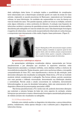 ATENÇÃO À SAÚDE DO ADULTO – TUBERCULOSE




dado radiológico desta forma. A cavitação implica a possibilidade de complicações
tanto relacionadas com a disseminação canalicular quanto em razão da erosão de vasos
arteriais, originando os pseudo-aneurismas de Rasmussen, responsáveis por hemoptises
vultosas, às vezes fulminantes. As cavidades são surpreendidas no curso da doença em
mais da metade dos casos. Têm paredes espessas, podem ser únicas ou múltiplas, variando
entre alguns milímetros a vários centímetros de diâmetro. A evolução mais freqüente da
tuberculose cavitária é a presença de opacidades acinares, denominadas de lesões satélites,
descobertas pela radiografia em mais da metade dos casos. Esta disseminação broncógena
é sugestiva de tuberculose, mesmo sendo excepcionalmente observada em outras doenças,
e compromete mais intensamente o lobo médio, língula e bases pulmonares. (Figura 3).
                  Figura 3




                                       Figura 3: Radiografia em PA, demonstrando imagem cavitária
                                       de paredes espessas, localizada no segmento apical do lobo
                                       superior direito, além de nódulos acinares compromentendo
                                       tanto o pulmão direito, quanto o esquerdo, configurando a
                                       disseminação broncógena própria da tuberculose.


      Apresentações radiológicas atípicas
      As apresentações radiológicas consideradas atípicas, representadas por formas
pseudotumorais e por alterações que envolvem os segmentos anteriores, estão
freqüentemente associadas a condições mórbidas, como diabetes mellitus e síndrome de
imunodeficiência adquirida. Nestas situações, assim como nas formas miliares, a tomografia
computadorizada do tórax (TC), mais especificamente a técnica de alta resolução, pode
demonstrar alterações não visualizadas na radiografia. Desta forma, a TC tem se mostrado
excelente método complementar à radiografia. Nas formas miliares, permite caracterizar
com mais precisão o infiltrado micronodular, demonstrando sua distribuição aleatória
e centrolobular. Permite ainda o estudo concomitante do mediastino, demonstrando
linfonodomegalias, às vezes de densidade heterogênea, dado este extremamente útil no
diagnóstico diferencial da pneumopatias associadas à AIDS.
       Nas formas pseudotumorais a TC é ainda mais útil, podendo demonstrar alterações
que sustentam a natureza benigna da lesão tais como aspectos da cavitação, ectasias
brônquicas que permeiam a massa e disseminação broncógena caracterizada pela presença
de nódulos acinares não visualizados na radiografia.

      3.1.3.3 Prova tuberculínica
       Indicada como método auxiliar no diagnóstico da tuberculose, a prova tuberculínica
positiva, isoladamente, indica apenas infecção e não é suficiente para o diagnóstico da
tuberculose doença.

                                            62
 