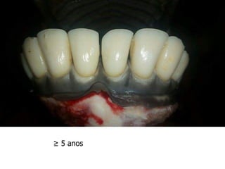 ≥ 5 anos
 
