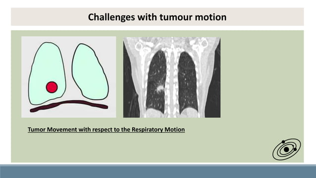 Significance of Robust Motion Management & Approaches In Radiotherapy ...