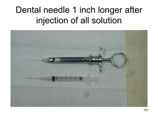 101
Dental needle 1 inch longer after
injection of all solution
 