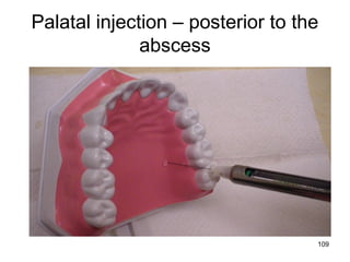109
Palatal injection – posterior to the
abscess
 