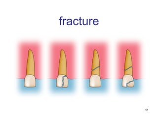 11
fracture
 