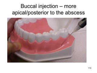 110
Buccal injection – more
apical/posterior to the abscess
 