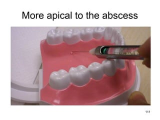 111
More apical to the abscess
 