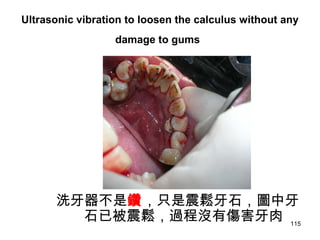 115
Ultrasonic vibration to loosen the calculus without any
damage to gums
洗牙器不是鑽，只是震鬆牙石，圖中牙
石已被震鬆，過程沒有傷害牙肉
 