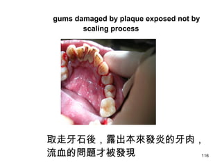 116
gums damaged by plaque exposed not by
scaling process
取走牙石後，露出本來發炎的牙肉，
流血的問題才被發現
 