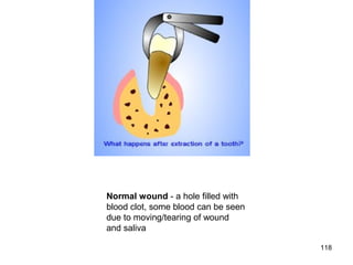 118
Normal wound - a hole filled with
blood clot, some blood can be seen
due to moving/tearing of wound
and saliva
 