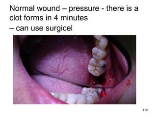 119
Normal wound – pressure - there is a
clot forms in 4 minutes
– can use surgicel
 