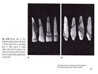 12
JO Andreasen et al. Textbook and Color Atlas of
]Traumatic Injuries to the Teeth 4th edition
 