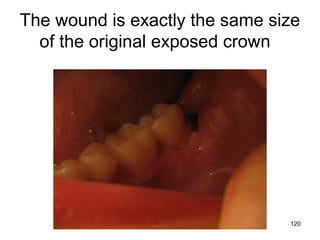 120
The wound is exactly the same size
of the original exposed crown
 
