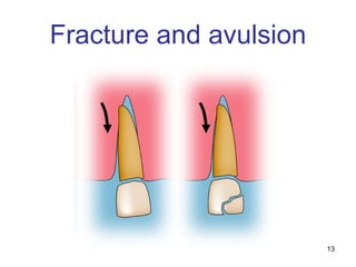 13
Fracture and avulsion
 