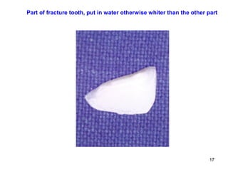 17
Part of fracture tooth, put in water otherwise whiter than the other part
 