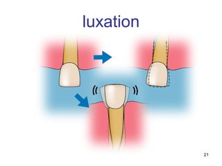 21
luxation
 